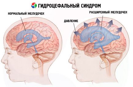 hydrocephalic синдром причини, симптоми, диагностика, лечение, които са компетентни за здравето на ilive