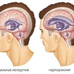 Hydrocephalic синдром хипертонична признаци и лечение smptomy заболяване
