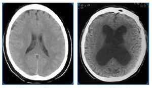 Хипертонична синдром, hydrocephalic деца и възрастни