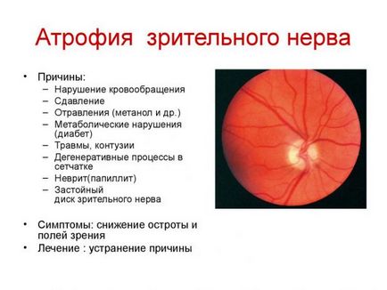 Глаукома - какво е за лечение, независимо дали вродени, диагностика, причинява, капки за очи,