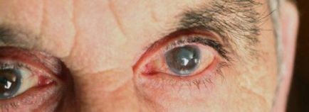 Глаукома - причини, симптоми, диагностика и лечение