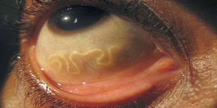 Червеи в очите на хората - на симптомите, начини на заразяване и лечение