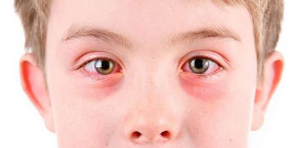 Червеи в очите на хората - на симптомите, начини на заразяване и лечение