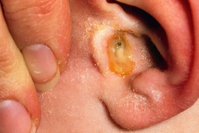 Гнойни възпаления на средното ухо - причини, симптоми, симптоми и лечение