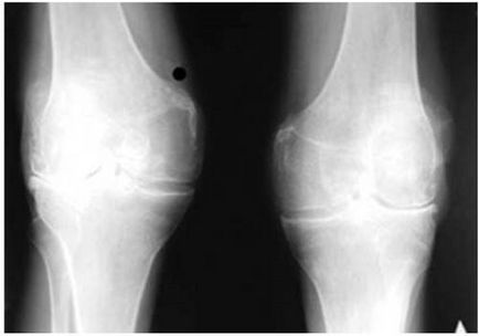Остеоартрит на коляното, какво е то и неговите видове, симптоми и лечение