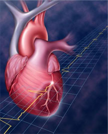 Инфаркт на миокарда и неговите форми