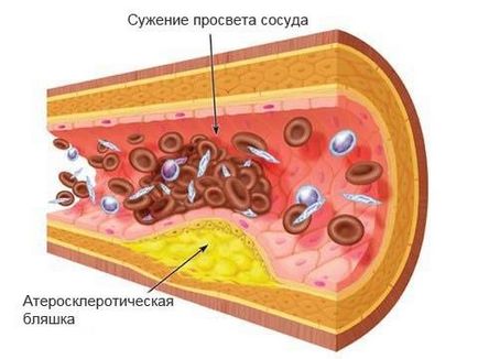 Исхемия причини, лечения, ефекти, степента и симптоми