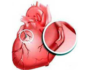 Исхемия на сърцето, което се причинява симптомите, методи за диагностика и лечение