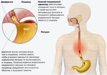 Киселини в стомаха причините, последиците и да се отърве от киселини в стомаха у дома