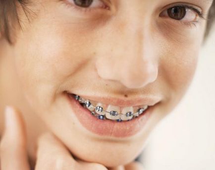 Какво по-добри скоби като възрастен, тийнейджър, дете стоматологични прегледи