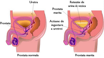 Какви лекарства за лечение на рак на простатата, облекчаване на аденом на няколко пъти по-бързо