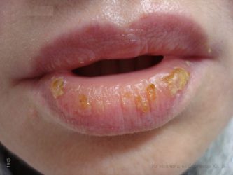 Как за лечение на хейлит върху устните на причините и симптомите на заболяването