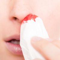Как да спрем кръвотечение от носа