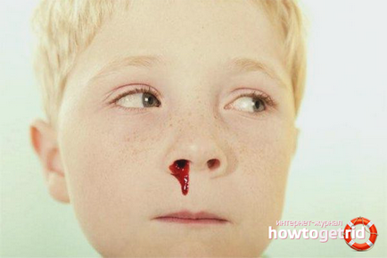 Как да спрем кръвотечение от носа у дома