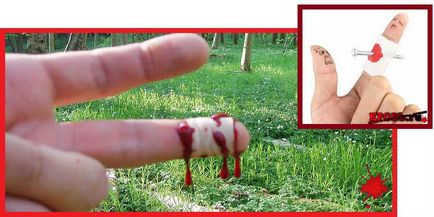Как да се спре кървенето от пръстите - лечение на кървене