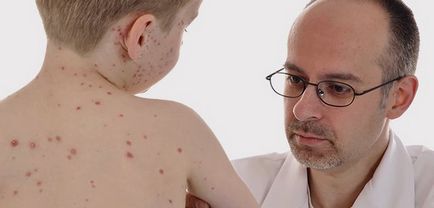 Как да се разграничи от варицела от алергии в снимка на детето, маса за сравнения
