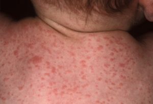 Как да се разграничи от вида на варицела алергични обриви, допълнителни симптоми