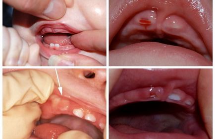 Как да растат зъби при деца схема, редът и появата на симптоми на зъб в устата