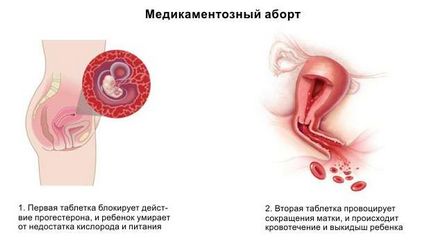 Как да направите аборт по време на бременност