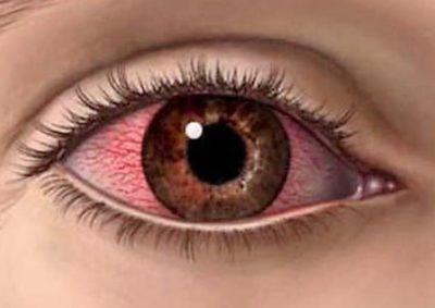 Как да се положи на тетрациклините мехлем за окото
