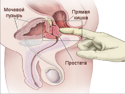 Калцификация в простатата причинява, диагностиката и лечението методи