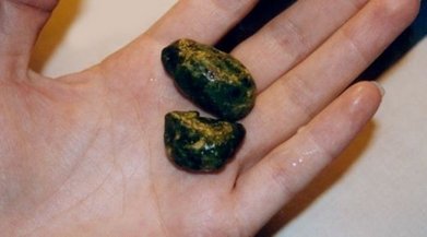 Камъни в черния дроб - описанието, причините, симптомите, лечението