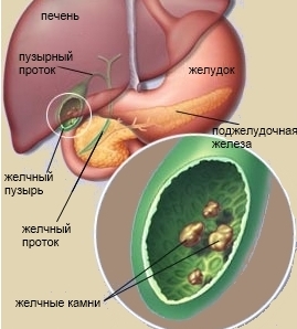 Камъни в жлъчката в симптомите на черния дроб, как да се отървете и лечение