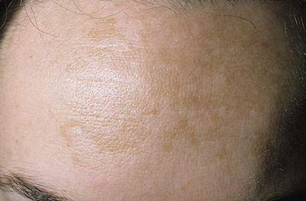 Кафяви петна по кожата на снимката, усложнения, лечение, образувания по кожата