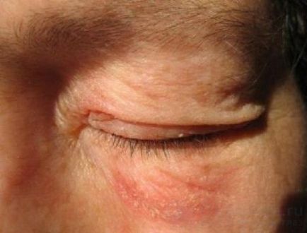 Червени петна под очите (причини, симптоми, лечение)