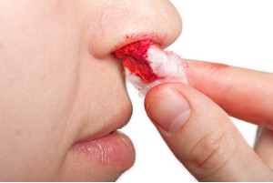 Кървене от носа как да се спре на видеото - жена и ден