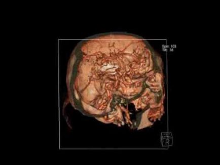 Rm съдове (CT) на мозъка и шията, сърцето и долните крайници, което е