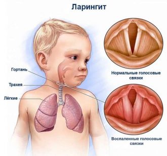 Ларингит - това е, причините, видове, лечение и профилактика