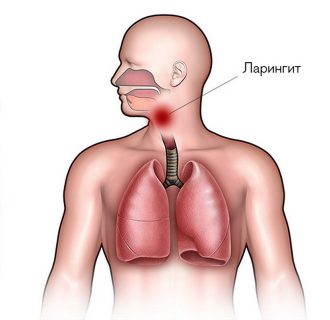 Ларингит - това е, причините, видове, лечение и профилактика