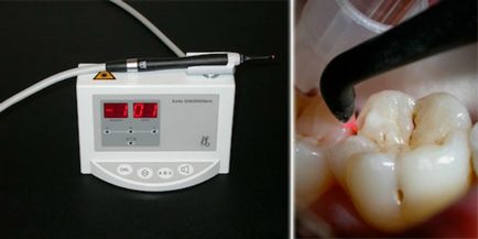 Лазерно лечение на зъбен кариес плюсове и минуси метод
