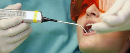 Лазерно лечение на зъбен кариес плюсове и минуси метод