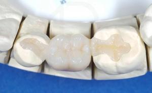 Лечение и протези на цена зъби