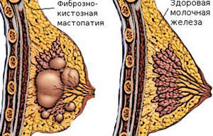Лечение народни средства за защита на гърдата възлова мастопатия, дифузна и фиброкистозна