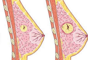 Лечение народни средства за защита на гърдата възлова мастопатия, дифузна и фиброкистозна