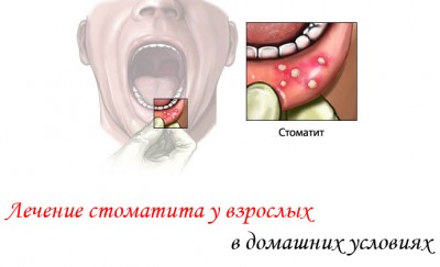 Лек за млечница в устата при възрастни, които са избрали