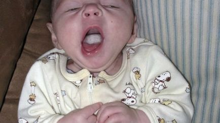 Гъбичките в симптомите на бебето в устата, снимка, форми, лечение, профилактика млечница