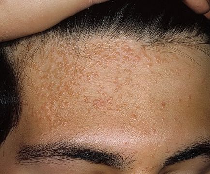 Растеж върху кожата под формата на снимка брадавици, как да се определи какво е то - царевица, пъпки или подкожно