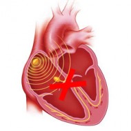 интравентрикулен проводимостта на сърцето, intraatrial