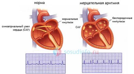 интравентрикулен проводимостта на сърцето, intraatrial