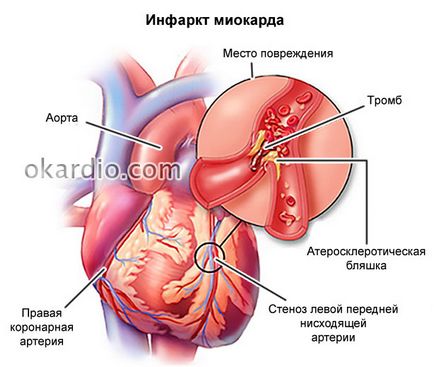 Нарушаване на интравентрикулен проводимостта на сърцето, че е