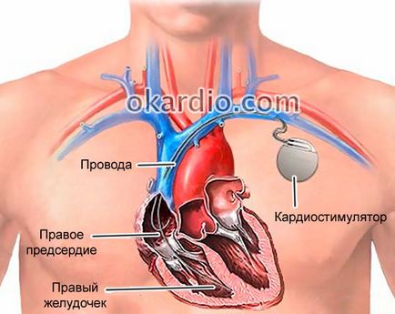 Нарушаване на интравентрикулен проводимостта на сърцето, че е