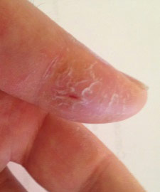 Oblazit кожата на пръстите на деца и възрастни обикновен дразнене или опасни заболявания