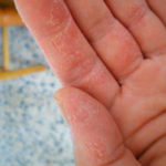Oblazit кожата на пръстите на деца и възрастни обикновен дразнене или опасни заболявания
