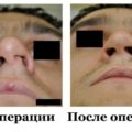 Операция rhinoseptoplasty носа цени, снимки, видео, коментари