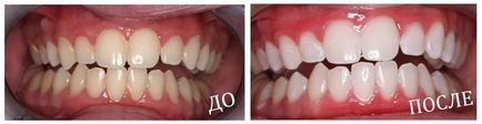 Избелване на зъби описание на въздушния поток, снимки, цена, ревюта
