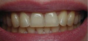 Избелване на зъбите с ултразвук - ревюта, цени, снимки преди и след